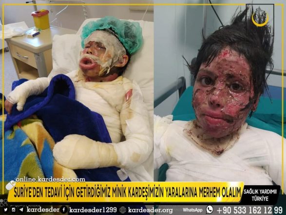 suriye den tedavi icin getirdigimiz minik kardesimizin yaralarina merhem olalim 04